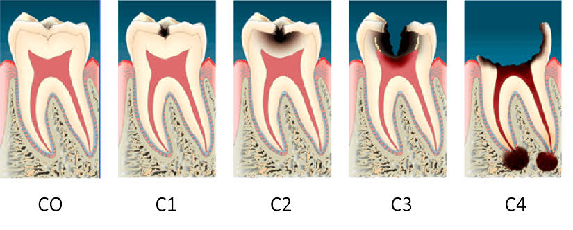 重度に進行したむし歯C4の治療方法