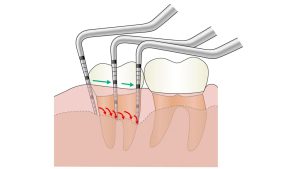 歯周検査6点法