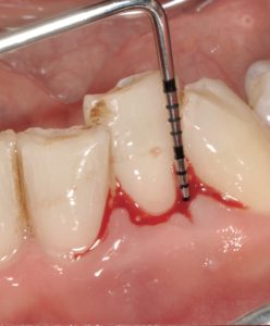 歯周検査6点法