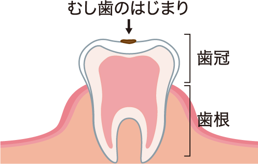 むし歯になる前兆です