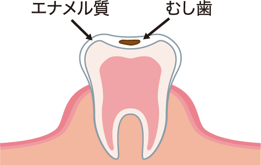 表面のエナメル質が溶け始めた浅いむし歯