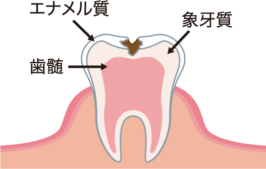 むし歯が進行し、象牙質まで達したもの