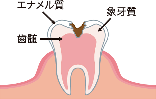 むし歯が神経まで達したもの