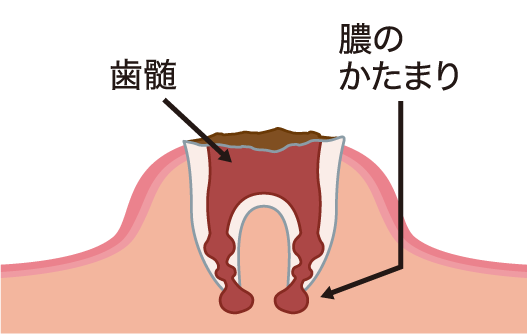 歯冠のほとんどが崩壊したもの