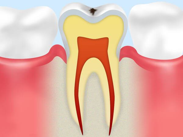 CO：ごく初期段階のむし歯