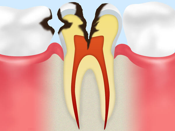 C3：神経にまで進行したむし歯