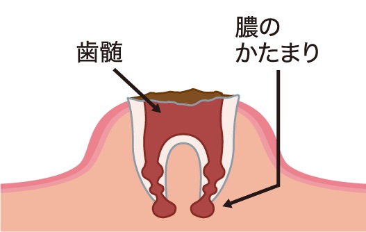 重度に進行したむし歯C4の治療方法