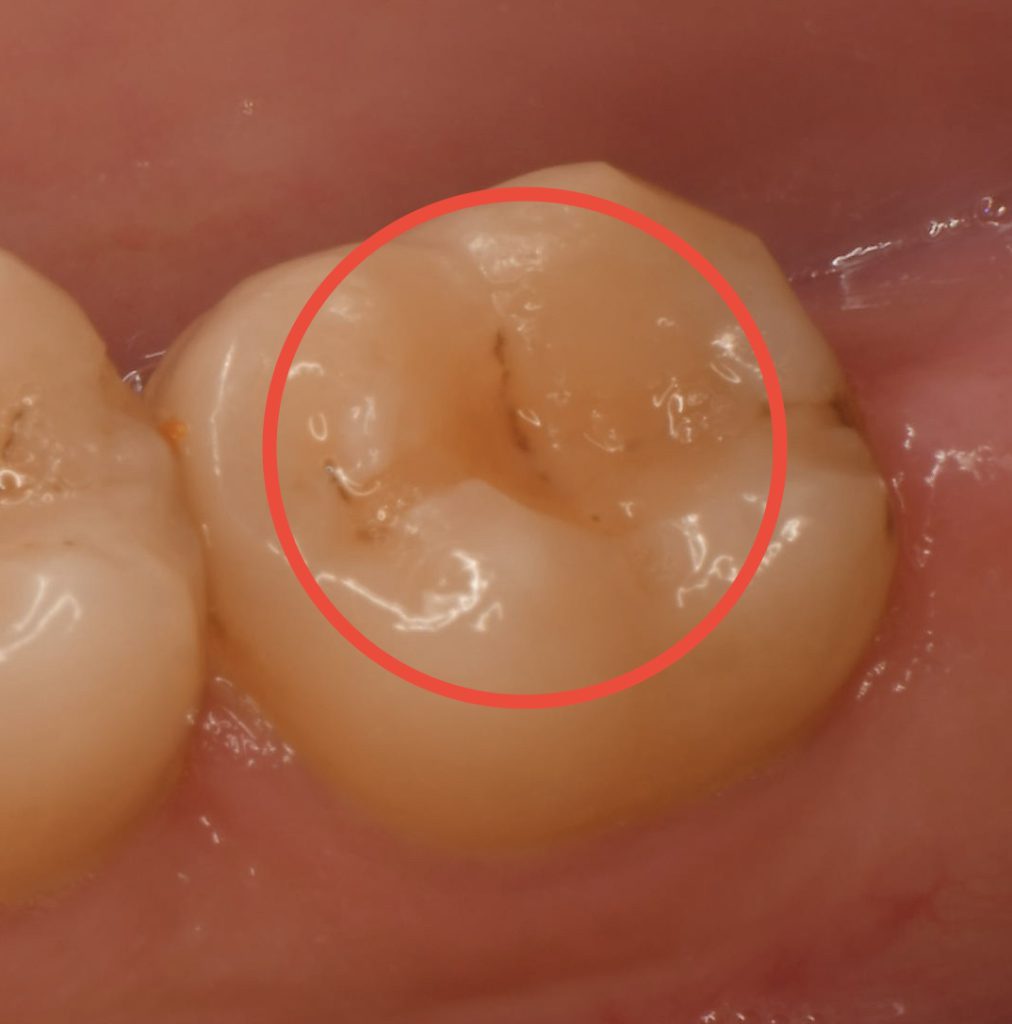 一度治した歯のむし歯