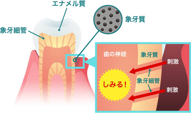 第45回　歯がしみる