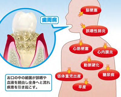 第60回　歯と関わりのある全身の病気